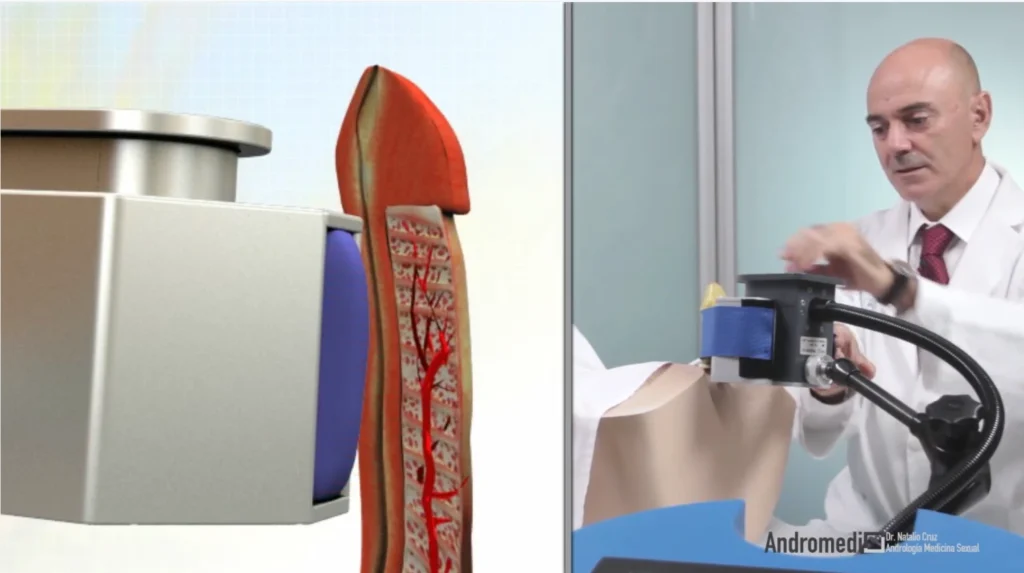 Tratamiento médico con ondas de choque para la disfunción eréctil en entorno clínico, con simulación anatómica y profesional de salud.